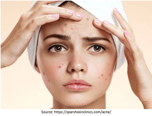You No Longer Have to Live with Acne Scars
