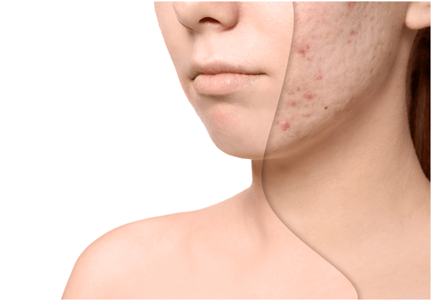 How to get rid of acne and scars in Hyderabad?