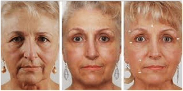 Fight the signs of your skin aging in Secunderabad