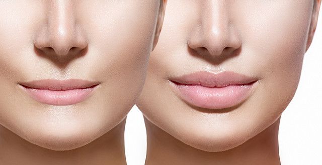 candidate for lip augmentation