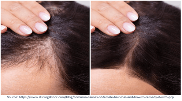 Non-Surgical Hair Fall Treatments & Their Effectiveness