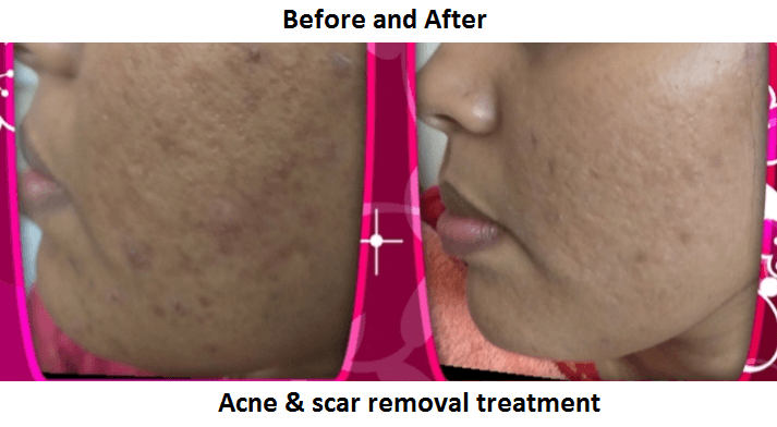 acne and scar removal