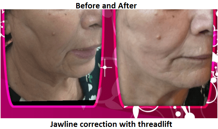 jawline-correction-with-threadlift