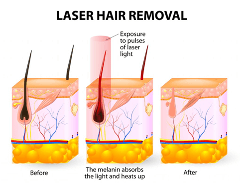 laser hair removal procedure