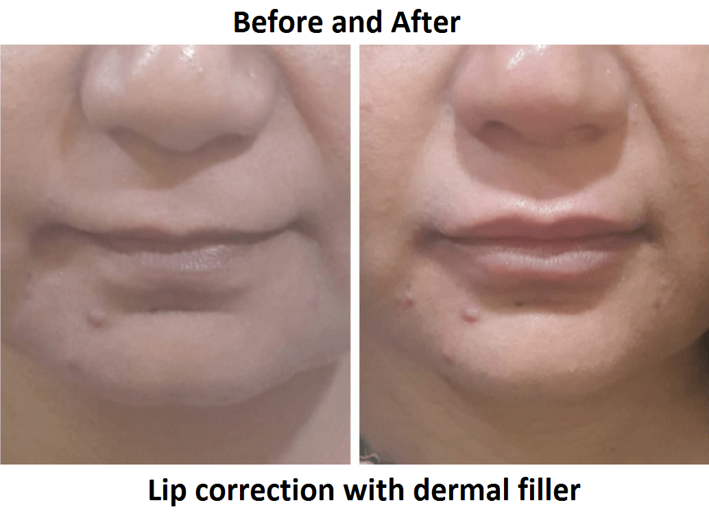lip-correction-with-dermal-filler